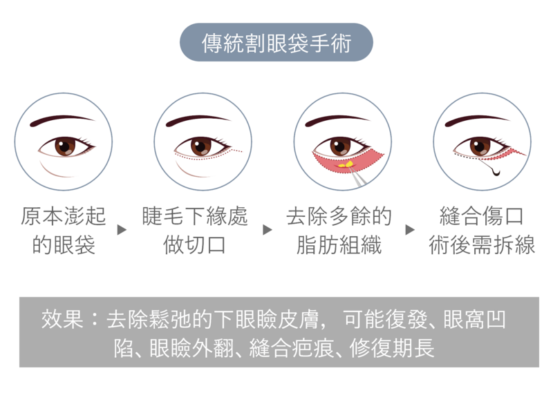 傳統眼袋手術只能改善單一眼袋問題，但可能產生疤痕與凹陷