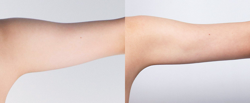 光澤診所抽脂案例1：手臂術前術後對比