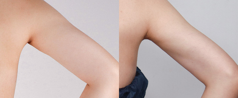 光澤診所抽脂案例2：手臂術前術後對比