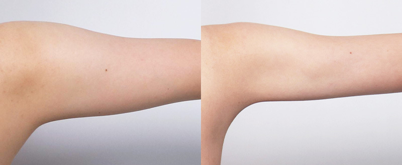 光澤診所抽脂案例3：手臂術前術後對比