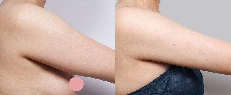 光澤診所抽脂案例4：手臂術前術後對比