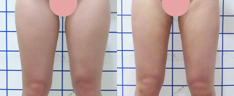 光澤診所抽脂案例8：手臂術前術後對比