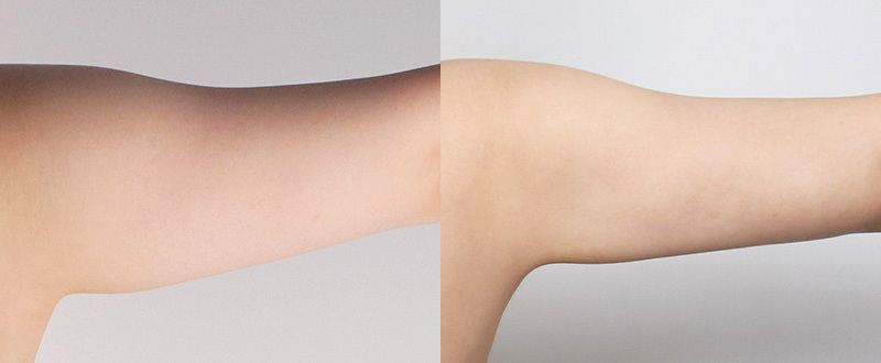 光澤診所抽脂案例5：手臂術前術後對比