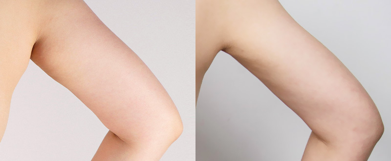 光澤診所抽脂案例6：手臂術前術後對比