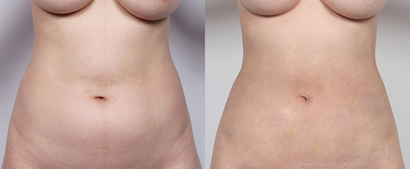 光澤診所抽脂案例7：手臂術前術後對比