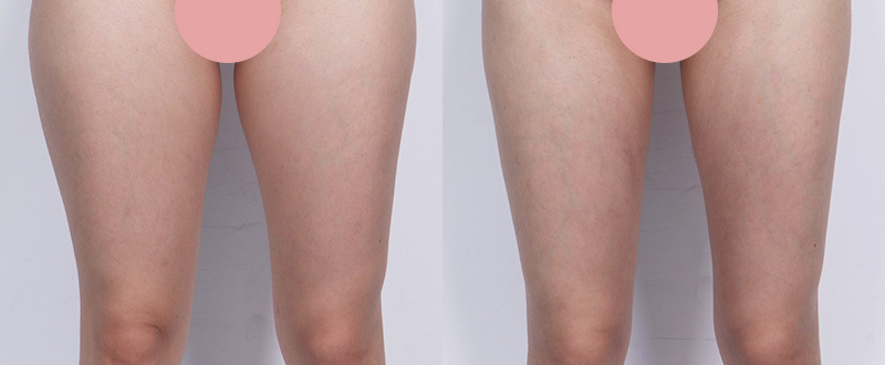 光澤診所抽脂案例9：手臂術前術後對比