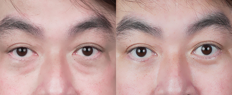 5D亮睛術案例：男性患者術前眼袋凸出、淚溝凹陷