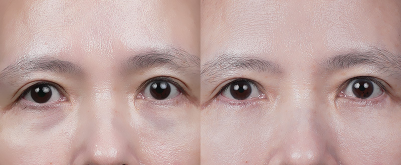 5D亮睛術案例：女性患者眼袋淚溝與蘋果肌凹陷改善