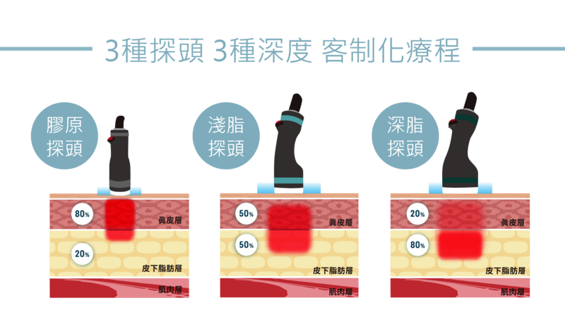 Onda Pro 三款探頭皆配備 即時冷卻裝置有效雕塑體態