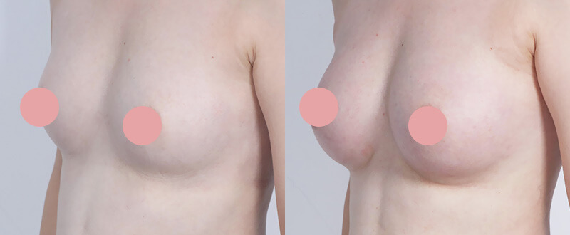 光澤診所自體脂肪隆乳案例1：自然美胸雕塑