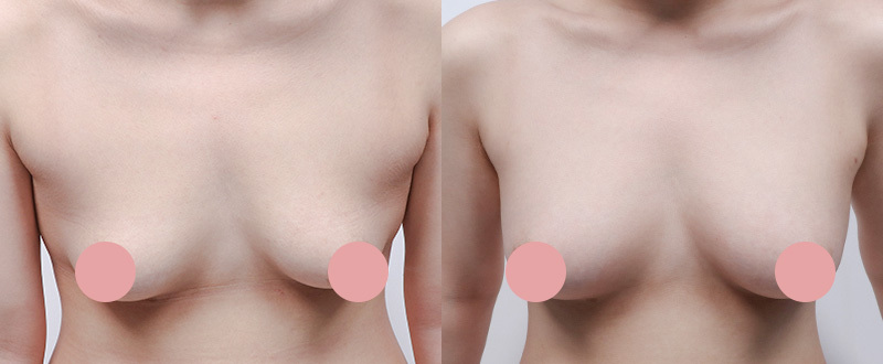 光澤診所自體脂肪隆乳案例3：改善不對稱與深邃溝影