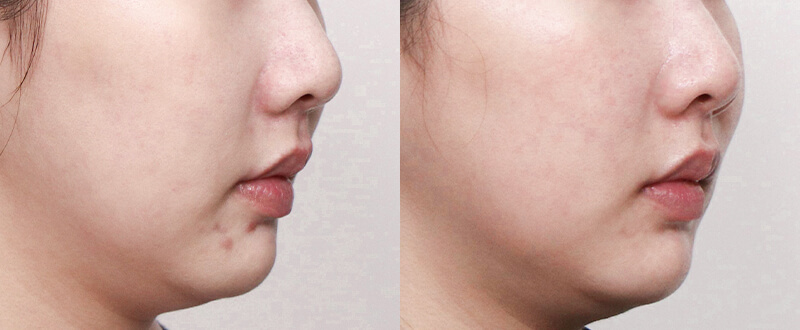 光澤診所染料雷射案例3