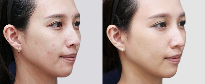 光澤診所染料雷射案例1