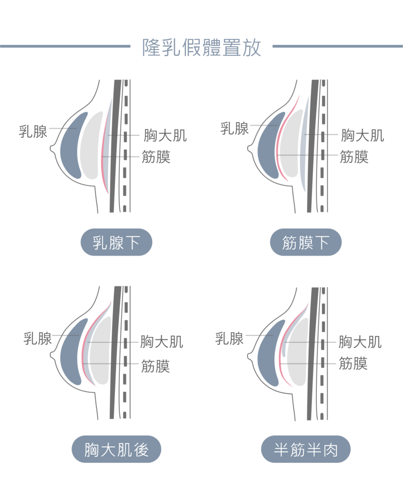 不同的隆乳假體位置，呈現的視覺效果，以及術後的身體感受都略有差異；專業醫師會依照客戶的身型比例，以及想要達到的隆乳效果，將假體植入最理想的位置。