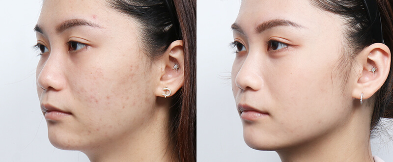 光澤診所染料雷射案例4