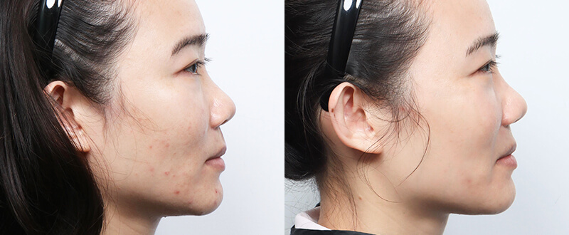 光澤診所染料雷射案例5