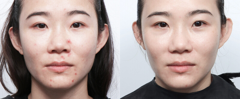 光澤診所染料雷射案例6