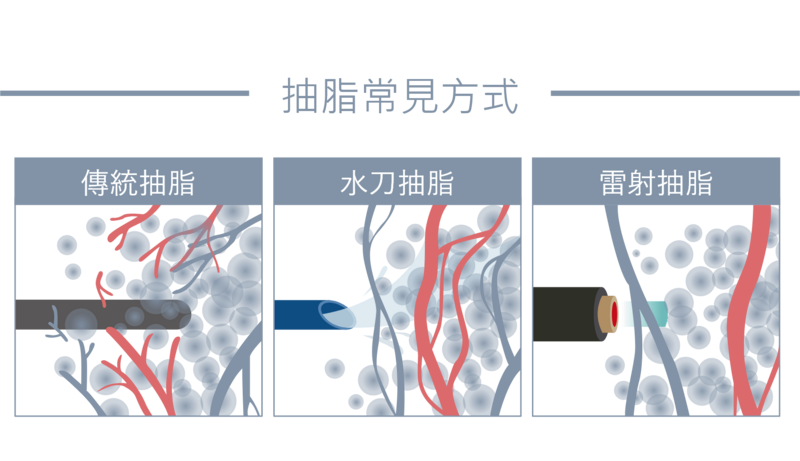 傳統抽脂的手術，對身體軟組織的傷害較大，施作過程可能導致血管與神經受損；光澤診所集結震動式抽脂、水刀抽脂、超音波抽脂、雷射減脂(破壞皮下脂肪細胞)的複合式抽脂，依各儀器的優勢，針對不同深度的脂肪作用，移除脂肪達到體態線條雕塑效果，專業精緻技術重現渾然天成的曲線。