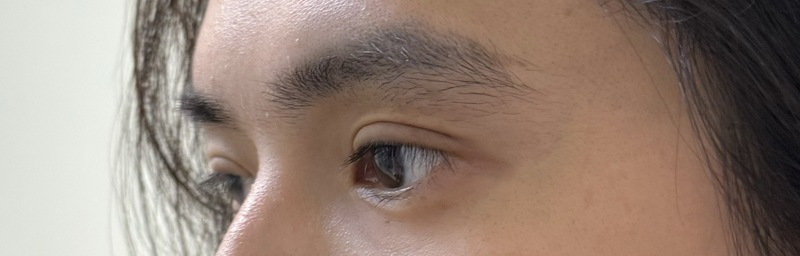 奇軒雙眼皮手術術後照：深邃眼神與自然摺痕展示