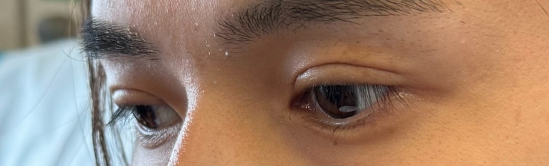 光澤診所美麗見證：奇軒眼神重塑全紀錄