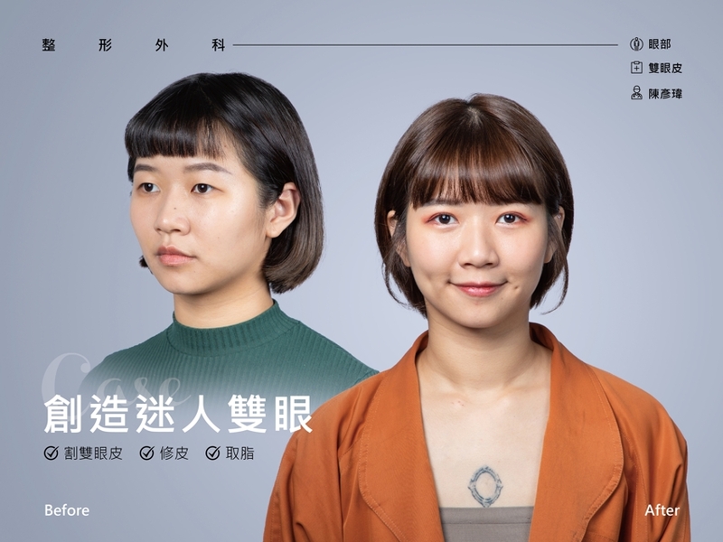 光澤診所雙眼迷手術超級成功案例大推薦光澤診所