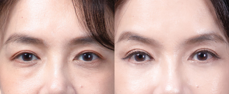 5D亮睛術術前術後案例 2