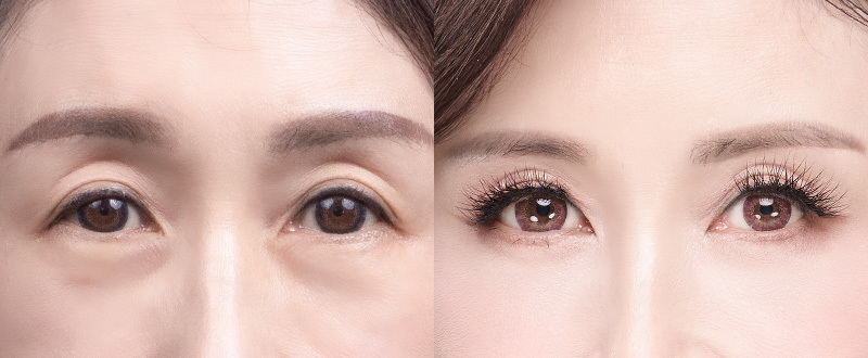 5D亮睛術術前術後案例 4