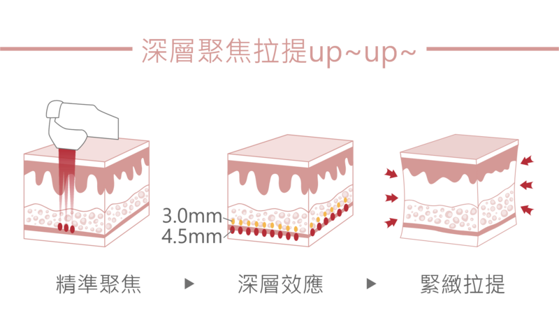 電波拉提的精準聚焦深達1.5mm 的皮下真皮層至4.5mm的深筋膜層，其能量變成微細的「熱點」，在皮下作用的溫度可到達65℃~70℃，熱能的深層效應使組織受熱收縮，且依治療部位的不同，會產生8,000~10,000個的獨立凝結點，能持續性激發身體的自我更新機制，讓膠原蛋白增生，使肌膚產生緊緻拉提的成效。