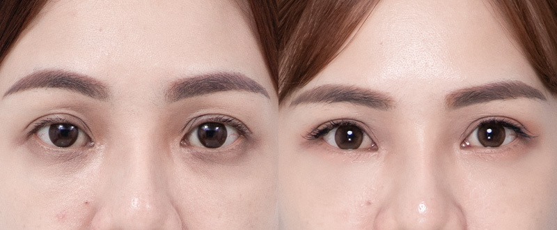 5D亮睛術術前術後案例 5