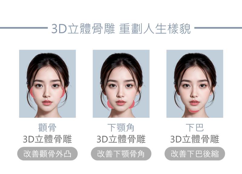 3D立體骨雕改善顴骨、下顎角與下巴輪廓示意圖