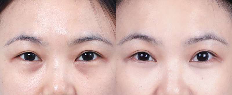 5D亮睛術術前術後案例 6