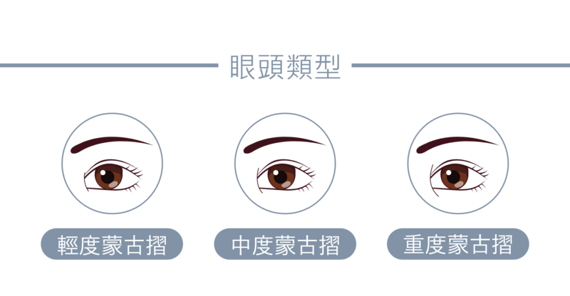蒙古摺是眼頭有贅皮增生，遮住內眥後形成封閉式的眼頭；輕微的內眥贅皮僅稍微遮到內眼角，有些則是延伸到下眼瞼形成中/重度的蒙古摺，這種情形發生在亞洲人的比例較高。若客戶同時有眼距較寬或單眼皮的困擾，光澤診所的醫師會依照實際情況，提供開眼頭手術的可行性和預期成果。