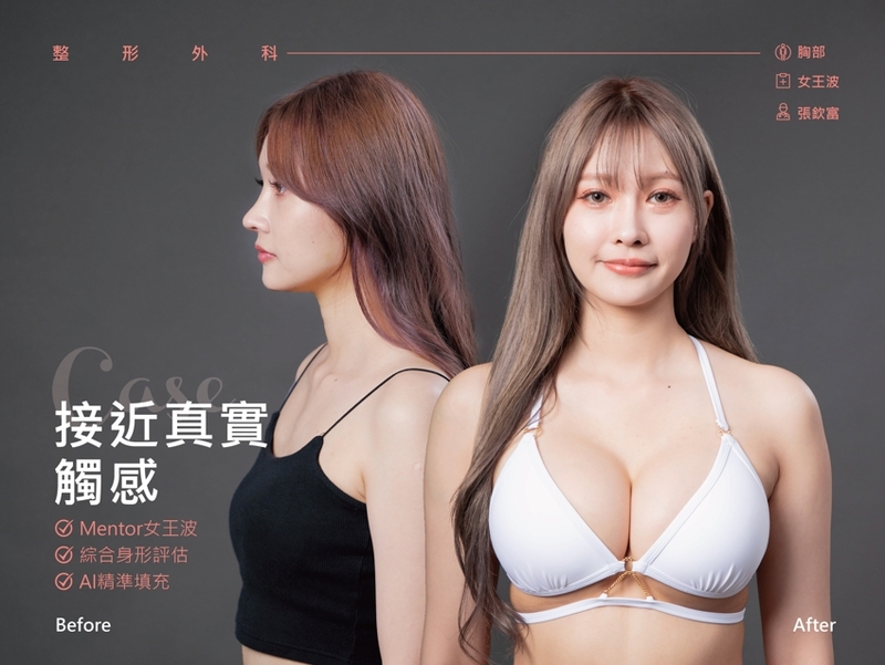 光澤診所女王波,超級隆乳成功案例,光澤診所推薦。
