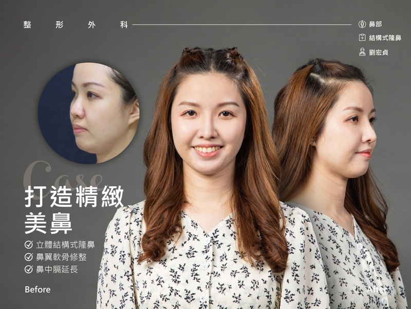 光澤診所隆鼻超級成功案例,光澤診所推薦。