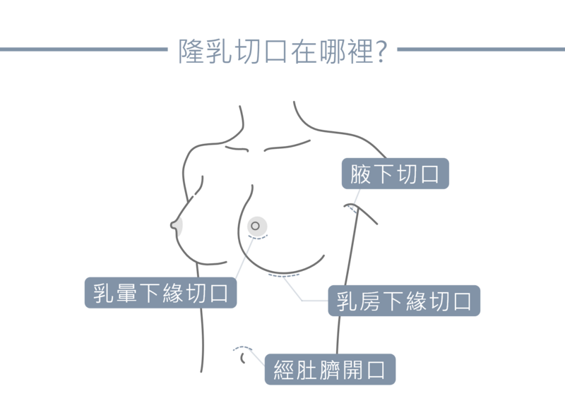 專業醫師會在隆乳手術之前，評估客戶的身體狀態，建議最合適的隆乳切口，再透過內視鏡手術將Motiva魔滴植體植入適當位置；腋下切口、乳暈下緣切口、乳房下緣切口、經肚臍開口等手術方式。