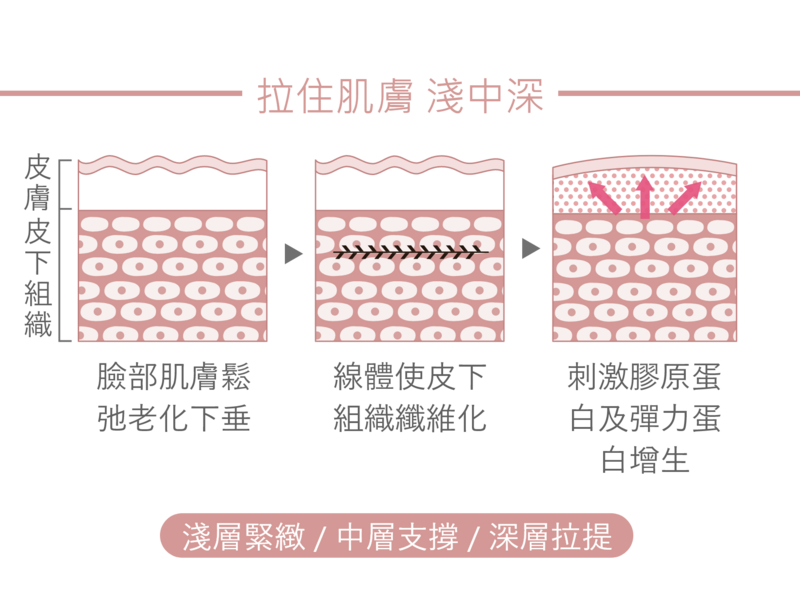 結構式線性拉提是依據每個人的臉型和結構所做的客製化拉提法，從臉的淺、中、深三個層面用線提拉起來，淺層緊緻、中層支撐架構、深層拉提。光澤診所的醫師會以注射的方式，將鈴鐺線深入皮下組織使其纖維化，刺激膠原蛋白與彈力蛋白增生，達到緊緻拉提的效果。