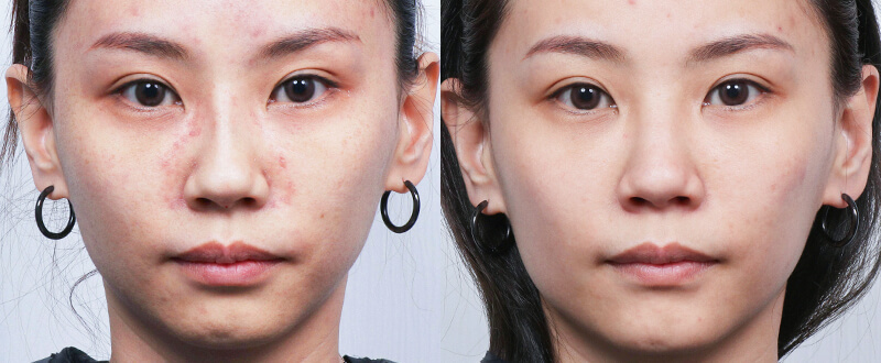 光澤診所皮秒雷射案例：深層斑點與顴骨斑改善對比