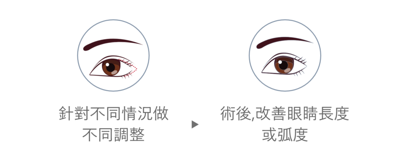 眼尾拉提：眼尾拉提手術則是針對眼睛內角的部分進行類似的微切口和拉提，以提高眼尾位置。若客戶有調整眼型的需求，但因為兩眼間距較近而不適合開眼頭時，專業醫師會評估開眼尾的可行性，並向客戶說明手術方式跟預期成果。