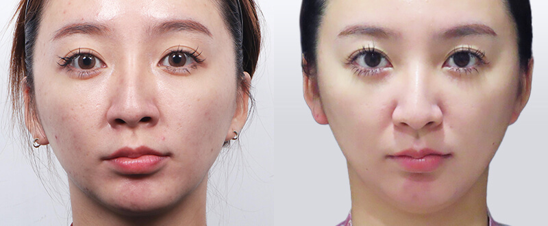 光澤診所皮秒雷射蜂巢模式：縮小毛孔與細緻膚質術後照