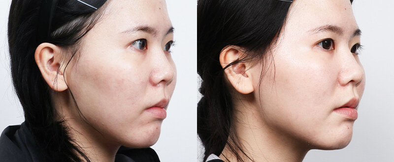 光澤診所皮秒雷射實例：全臉掃黑祛黃與膚色不均改善