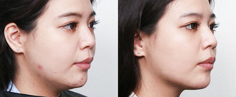 光澤診所複合式皮秒雷射：除斑亮白與細紋修復成效