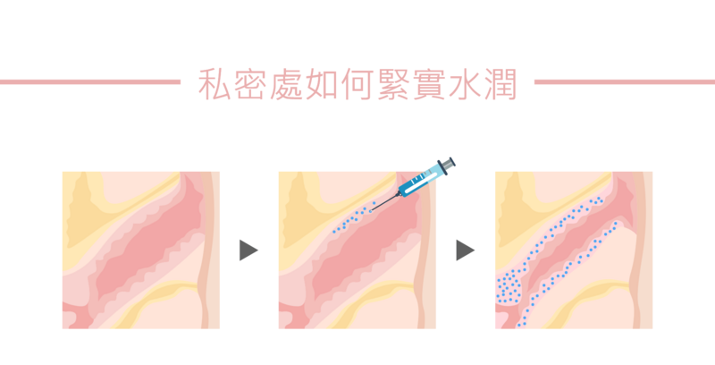 女性的私密處可能會隨時間老化，或是產後的影響，失去原有的緊實和水潤；G點玻尿酸填補，在歐美國家已經行之有年了，透過在私密處注射玻尿酸的微整形，對提升該部位的緊實水潤有顯著效果。