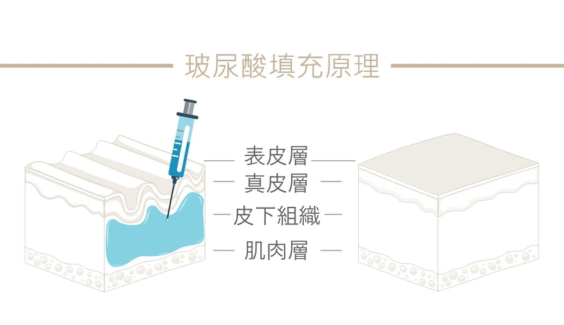 現今醫學美容所使用的填充玻尿酸產品，屬人工合成非動物性玻尿酸，用於皮下注射，能與體內原有的透明質酸融合，使得皮膚膨漲、細紋變平隆起，用來修飾深淺不同的凹陷皺紋，效果佳且安全性高，亦能幫助肌膚從表層吸取大量水分，增強皮膚長時間的保水能力。