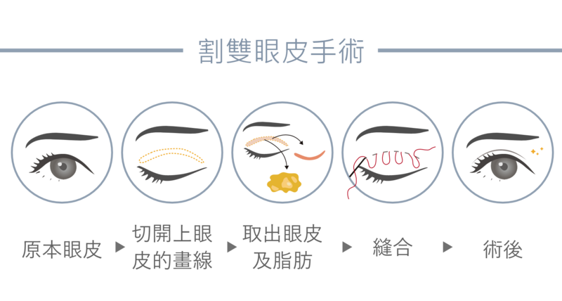 年紀較長、眼皮脂肪肥厚，或先天眼皮鬆弛、下垂者，且有大小眼困擾的者，則適合選擇用割的方式進行手術。