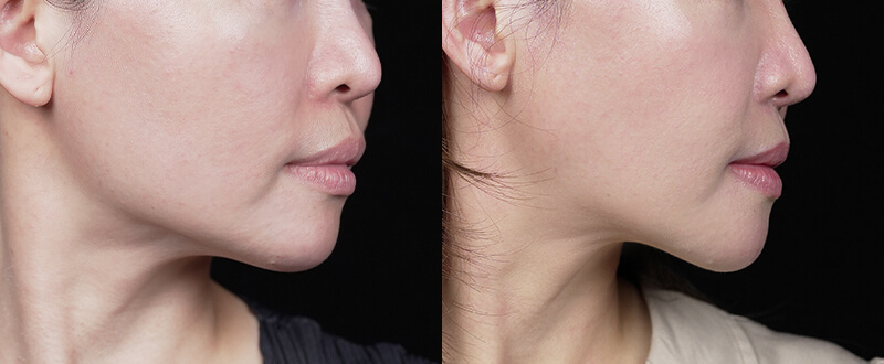 光澤診所3D立體骨雕案例2：下巴輪廓與V臉線條