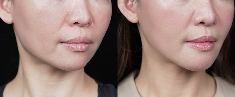 光澤診所3D立體骨雕案例1：鼻形雕塑與山根加高