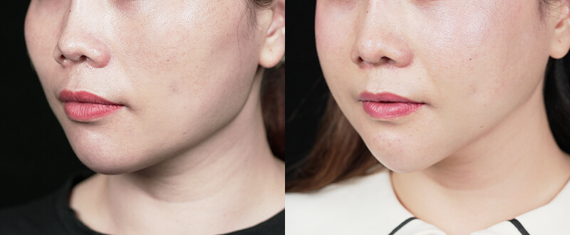 光澤診所3D立體骨雕案例3：蘋果肌支撐與中臉拉提