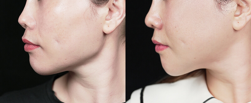 光澤診所3D立體骨雕案例4：額頭飽滿與夫妻宮填補