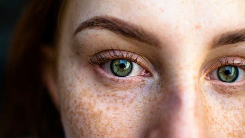 長肝斑代表肝不好？正確除斑3步驟