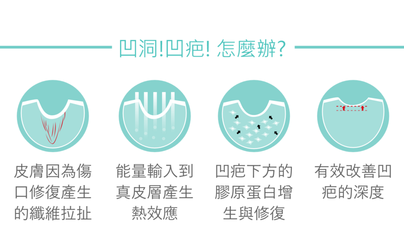 二代飛梭雷射治療時在肌膚上製造數以千計的細小深入傷口，即所謂的顯微加熱區(能量輸入到真皮層產生熱效應)。雷射能量穿透到400到700微米的皮膚深度，便會啟動膠原蛋白增生以及自我修復，進而有效改善凹疤的深度。